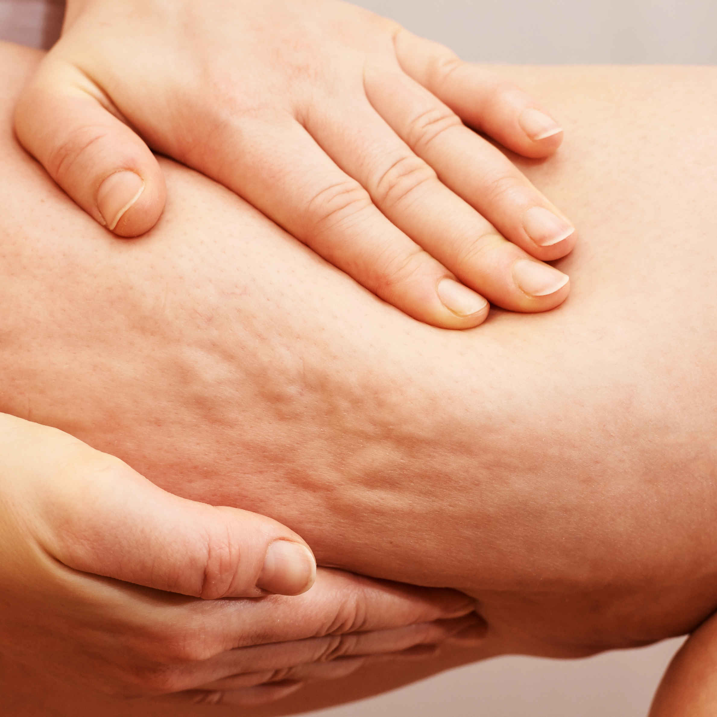 Cellulite Behandlung Düsseldorf
